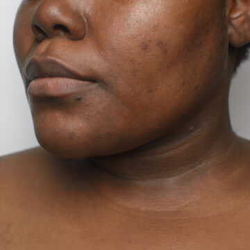 Sun Damage & Pigmentation