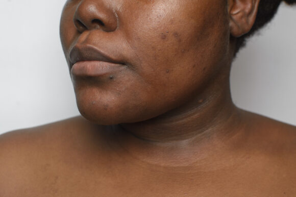 Sun Damage & Pigmentation