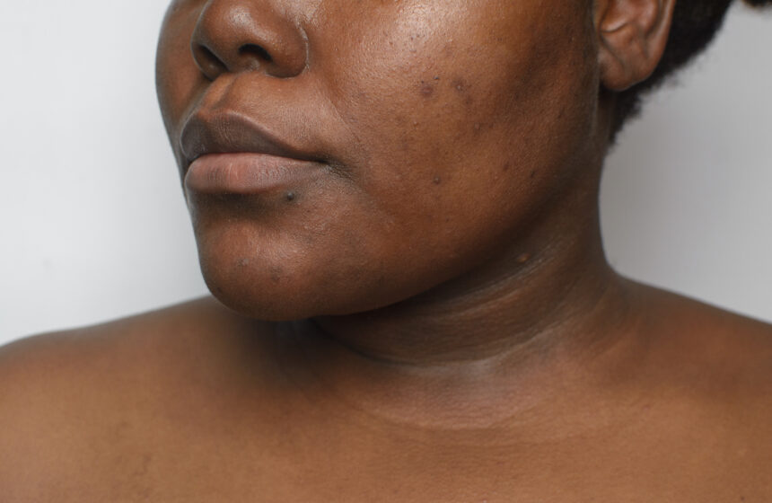 Sun Damage & Pigmentation