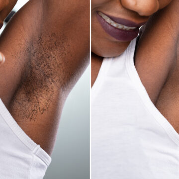 Unwanted Hair