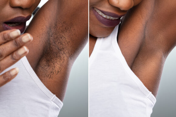 Unwanted Hair